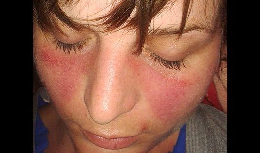 Lupus Symptome - Schmetterlingserythem