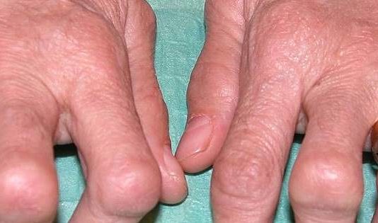 Rheumatoide Arthritis Prognose- Gelenke