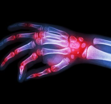 Was ist rheumatoide Arthritis? Röntgen Hand geschwollen