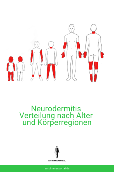 Neurodermitis betroffene Körperstellen nach Alter