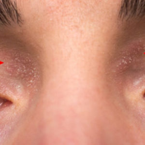 Neurodermitis an den Augen