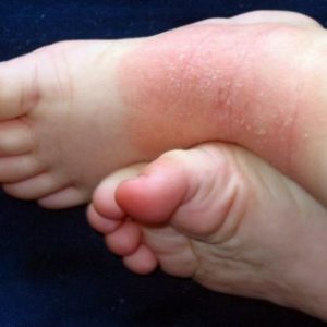 Neurodermitis an den Füßen