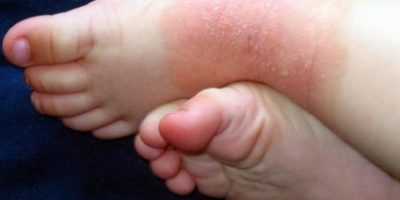 Neurodermitis an den Füßen