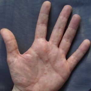 Neurodermitis an den Händen, Dishydrosis