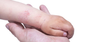 Eczema on the kid’s hand