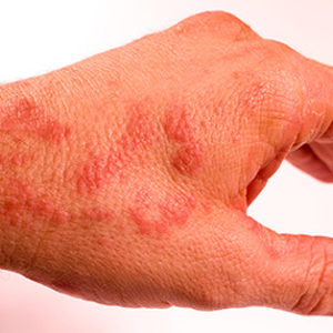Neurodermitis an den Händen (c)bkk24
