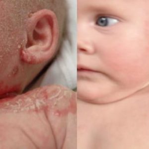 Neurodermitis bei Babys im Gesicht (c)openpr.de