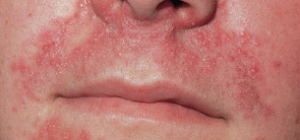 Neurodermitis im Gesicht (c)allergiefreie-allergiker