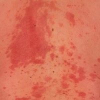 Psoriasis vulgaris ohne Schuppung (c)enzyklopaedie-dermatologie.de