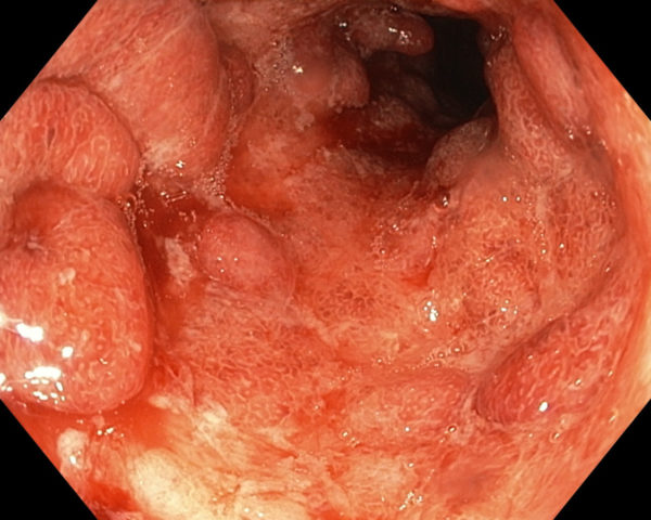 Colitis Ulcerosa Bilder, Abbildung 1: Endoskopie einer aktiven Colitis Ulcerosa mit Geschwüren. Die Schleimhaut ist großflächig entzündet.