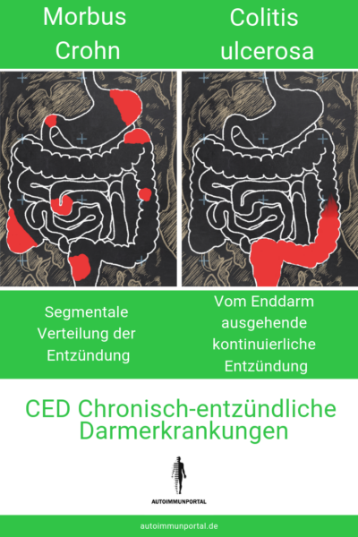 CED Chronisch-entzündliche Darmerkrankungen, Crohn und Colitis im Vergleich