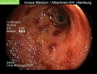 Colitis Ulcerosa Entzündung, Abbildung 4: Colitis Ulcerosa im schwer entzündeten Zustand. Die Schleimhaut ist stark entzündet, es kommt zu kleinen Einblutungen.