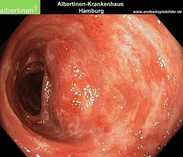 Colitis Ulcerosa Bilder, Abbildung 2: Endoskopie einer aktiven Colitis Ulcerosa mit großflächiger Eiterbildung und Entzündung.