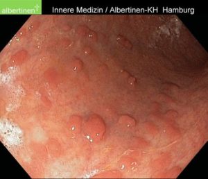 Abbildung 3: Colitis Ulcerosa mit geringfügiger Entzündung, aber mit Bildung von Pseudopolypen. Dies sind Wucherungen der Darmschleimhaut.