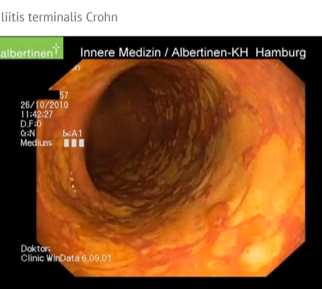 Ileitis terminalis crohn