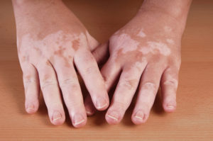 Vitiligo Hände