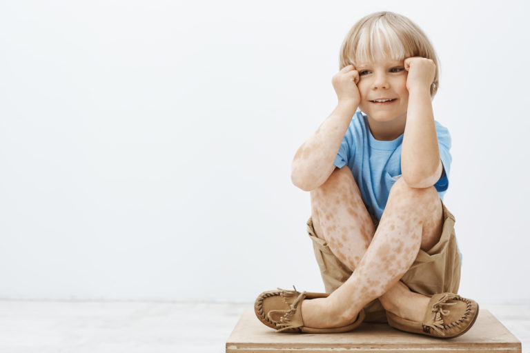 Vitiligo Kind Symptome weiße Flecken